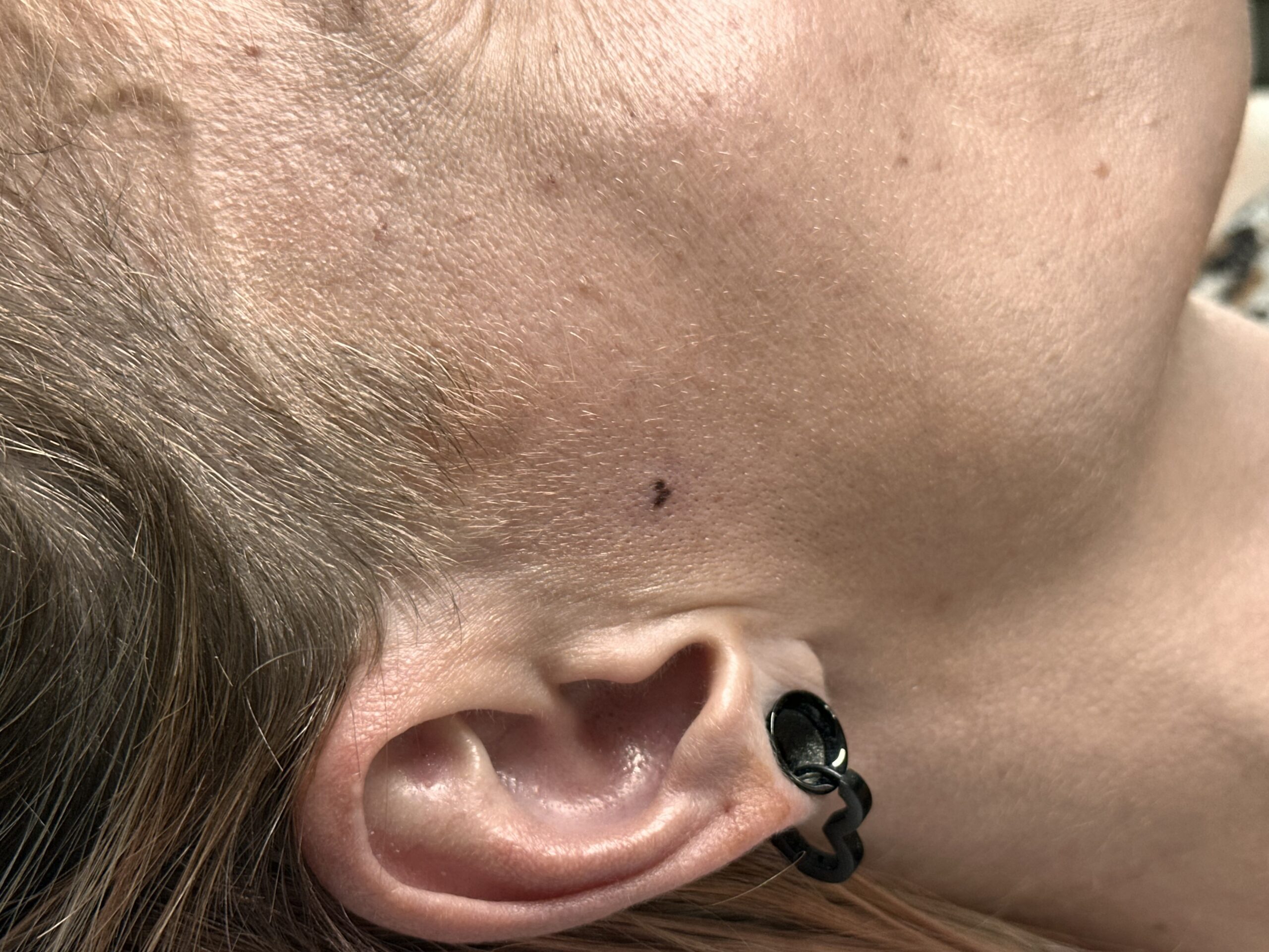 Grain de beauté pigmentaire discret réalisé par 6rius
