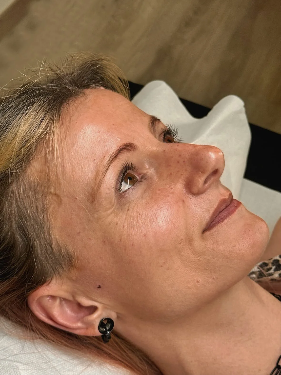 Taches de rousseur et grains de beauté semi-permanents réalisés à Mulhouse